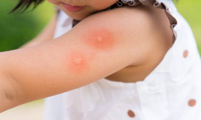 Trẻ em mắc sốt xuất huyết hạ sốt vẫn có thể diễn biến nặng